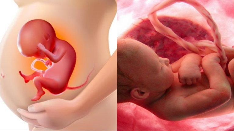 Amniotic Fluid Embolism